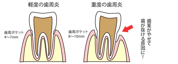 歯周炎