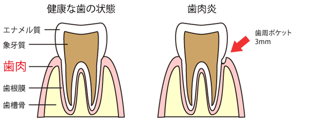 歯肉炎