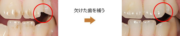 ラミネートベニアの症例